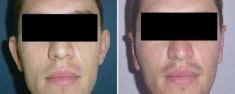 Ear surgery (Otoplasty) - Photo before - Dr. Dobos Calin