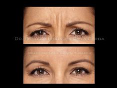Botulinum toxin - Wrinkle Removal - Photo before - Dr. Rodrigo Morales De la Cerda