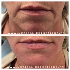 HIFU thérapie (lifting médical) - Cliché avant - Dr AMAT - ????Greffe FUE 2.0 Medic Xpert