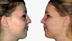 Operácia nosa (Rhinoplastika) - Fotka pred - GÉVÉ Klinika
