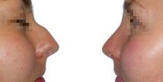 Operácia nosa (Rhinoplastika) - Fotka pred - GÉVÉ Klinika