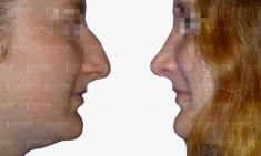 Operácia nosa (Rhinoplastika) - Fotka pred - GÉVÉ Klinika