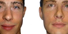 Operácia nosa (Rhinoplastika) - Fotka pred - GÉVÉ Klinika