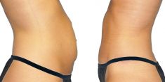 Abdominoplastika (Operácia brucha) - Fotka pred - GÉVÉ Klinika