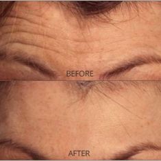 Dermal fillers - Photo before - Dr. Mahmood Kara