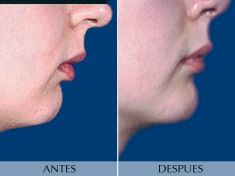 Mentoplastia - Foto Antes de - Clínica Planas