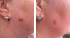 Odstranění znamének, kožních výrůstků - fotka před - Esthé Laser Clinic