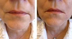 Výplně na bázi kyseliny hyaluronové - fotka před - Esthé Laser Clinic