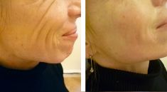 Výplně na bázi kyseliny hyaluronové - fotka před - Esthé Laser Clinic