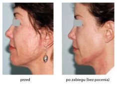 Nieinwazyjny lifting - Zdjęcie przed - Revival Clinic - Klinika Medycyny Estetycznej i Laseroterapii