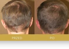 Hair Transplant - Photo before - Dr Turowski Hair Restoration Clinic