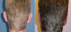 Ear surgery (Otoplasty) - Photo before - Dr. Dobos Calin