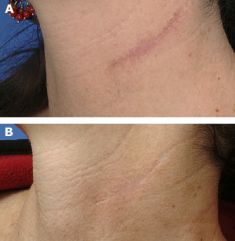 Fractional Laser Resurfacing - Photo before - Bieńkowscy Clinic®