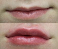 Lip augmentation - cheiloplasty - Photo before - ARS ESTETICA – Klinika Medycyny Estetycznej i Laseroterapii