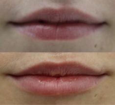 Lip augmentation - cheiloplasty - Photo before - ARS ESTETICA – Klinika Medycyny Estetycznej i Laseroterapii
