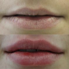Lip augmentation - cheiloplasty - Photo before - ARS ESTETICA – Klinika Medycyny Estetycznej i Laseroterapii