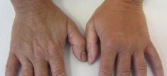 Exilis - Zdjęcie przed - Revival Clinic - Klinika Medycyny Estetycznej i Laseroterapii