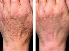 Odstranění pigmentových skvrn - fotka před - Esthé Laser Clinic
