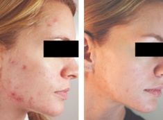 Laserová léčba akné - fotka před - Esthé Laser Clinic