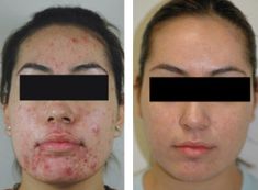 Laserová léčba akné - fotka před - Esthé Laser Clinic