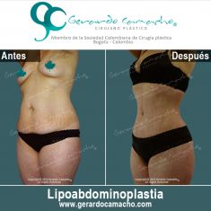 - Foto Antes de - Dr. Gerardo Camacho
