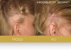 Hair Transplant - Photo before - Dr Turowski Hair Restoration Clinic