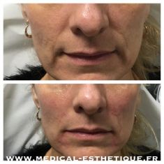Injections de comblement - Cliché avant - Dr AMAT - ????Greffe FUE 2.0 Medic Xpert