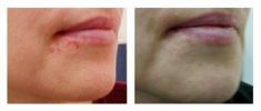 Scar removal - Photo before - Klinika Laser Esthetic