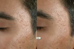 Radiofrequency Rejuvenation (Aluma, accent, TriPollar, Spa RF device, Re-Age) - Photo before - Klinika Laser Esthetic