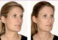 Hyaluronic acid-based wrinkle fillers - Photo before - Dr. Dobos Calin