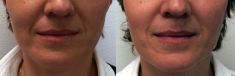 Injekční výplně - fotka před - MUDr. Evžen Trupar Ph.D.