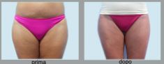 Mesoterapia (rivitalizzazione del viso, collo, decoltè, mani) - Foto del prima - Dott. Luca Leva Chirurgo Plastico