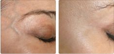 Spider veins laser removal (redness, birh marks) - Photo before - Bieńkowscy Clinic®