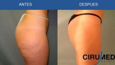 Liposucción - Foto Antes de - Cirumed Clinic
