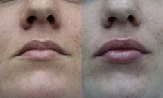 Lip augmentation - cheiloplasty - Photo before - ARS ESTETICA – Klinika Medycyny Estetycznej i Laseroterapii