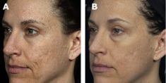 Fractional Laser Resurfacing - Photo before - Bieńkowscy Clinic®