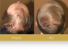 Hair Transplant - Photo before - Dr Turowski Hair Restoration Clinic