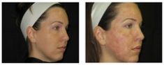 Radiofrequency Rejuvenation (Aluma, accent, TriPollar, Spa RF device, Re-Age) - Photo before - Klinika Laser Esthetic