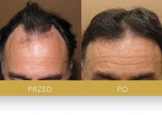 Hair Transplant - Photo before - Dr Turowski Hair Restoration Clinic