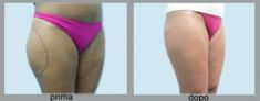 Mesoterapia (rivitalizzazione del viso, collo, decoltè, mani) - Foto del prima - Dott. Luca Leva Chirurgo Plastico