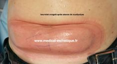 Cryolipolyse - Cliché avant - Dr AMAT - ????Greffe FUE 2.0 Medic Xpert