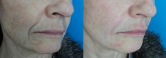 Injekční výplně - fotka před - MUDr. Evžen Trupar Ph.D.