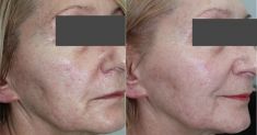 Fractional Laser Resurfacing - Photo before - ARS ESTETICA – Klinika Medycyny Estetycznej i Laseroterapii