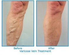 Varicose veins treatment - Photo before - Dr. Jain Best Cosmetic Surgery Clinic in UK