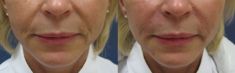 Injekční výplně - fotka před - MUDr. Evžen Trupar Ph.D.