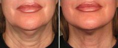 Ulthera - nieinwazyjny lifting - Zdjęcie przed - dr Krystyna Lubelska