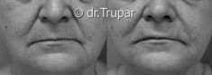Injekční výplně - fotka před - MUDr. Evžen Trupar Ph.D.