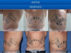 Liposucción - Foto Antes de - Cirumed Clinic