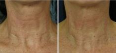 Radiofrequency Rejuvenation (Aluma, accent, TriPollar, Spa RF device, Re-Age) - Photo before - Klinika Laser Esthetic