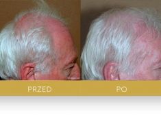 Hair Transplant - Photo before - Dr Turowski Hair Restoration Clinic